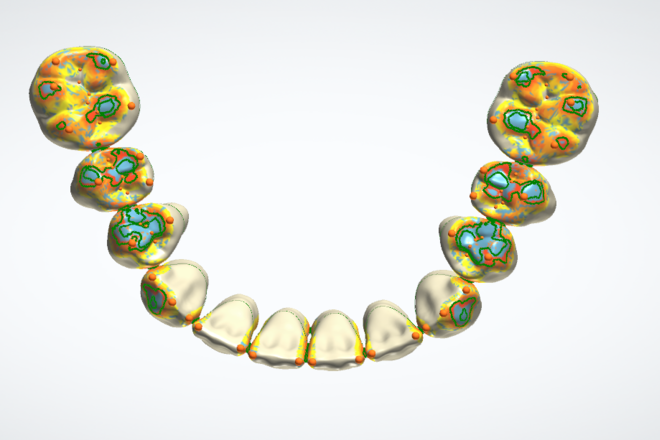 Complete denture / Over-denture - CadCam Masters