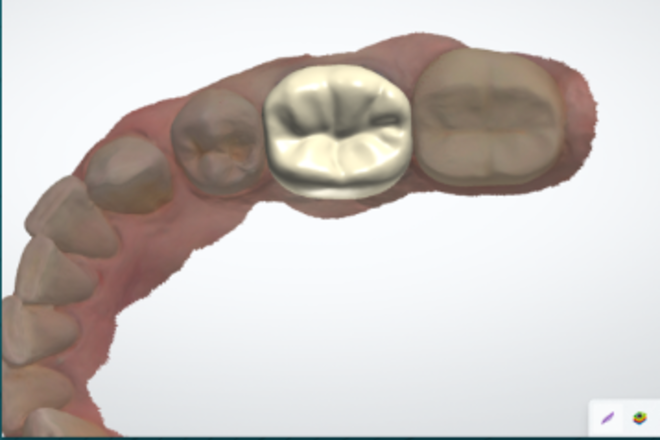 crown and bridge - CadCam Masters