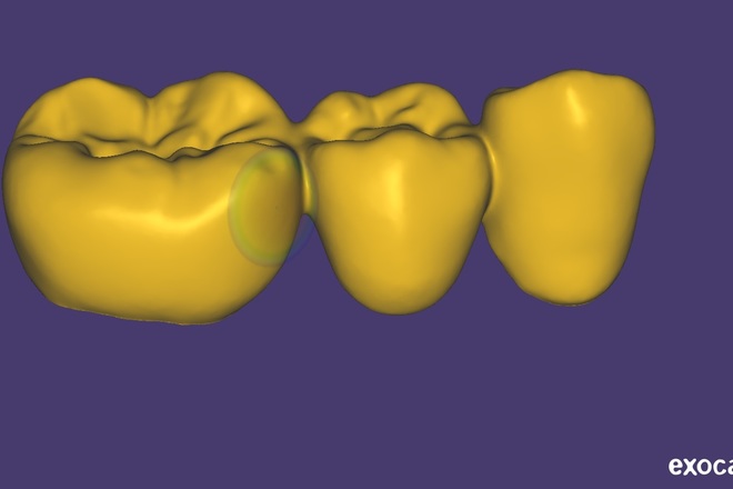 CROWNS AND BRIDGES - CadCam Masters