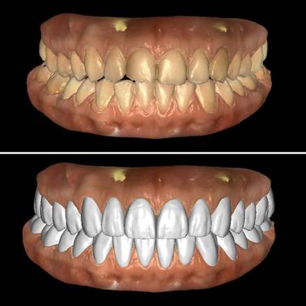 Wax up with Digital smile design - CadCam Masters