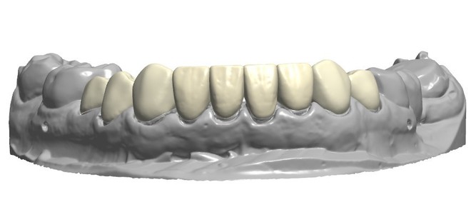 Crowns and bridges - CadCam Masters