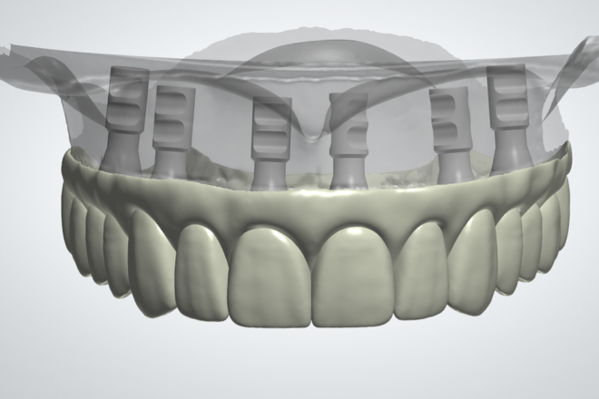 All On 4/6/X - CadCam Masters
