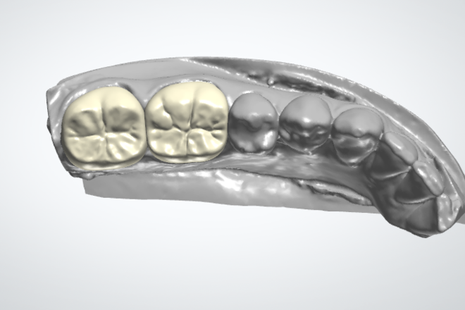 Single Crown and Bridges - CadCam Masters
