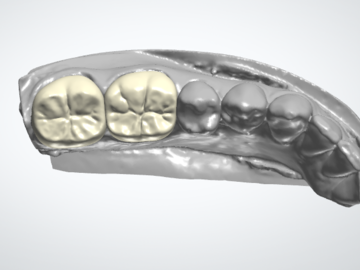Dental Cad Service: Single Crown and Bridges