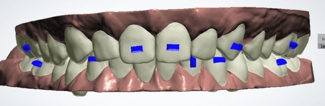 Digital Aligners - CadCam Masters