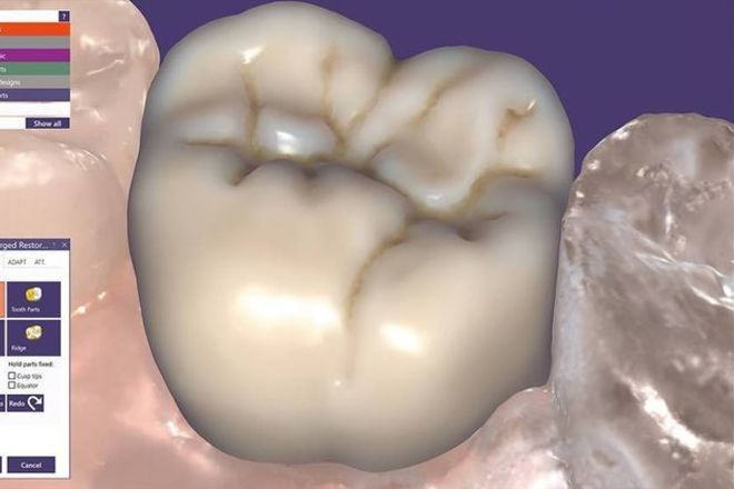 Crowns and bridges - CadCam Masters