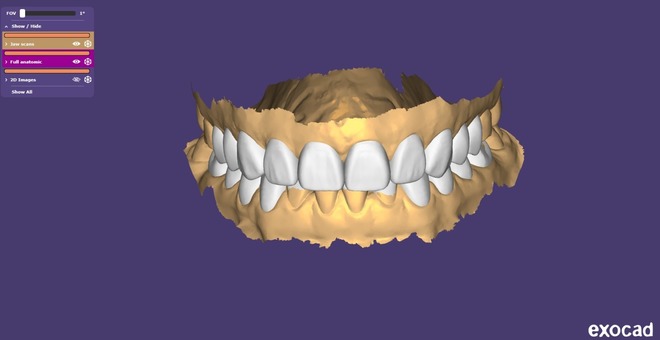 Digital Diagnostic Mock Up, Wax Up – CAD Design