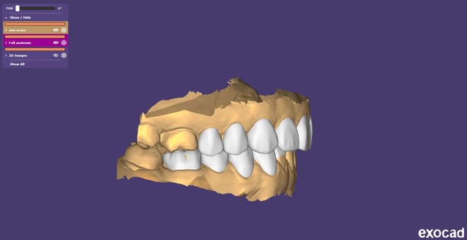 Digital Diagnostic Mock Up, Wax Up – CAD Design