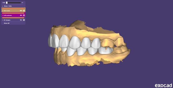 Digital Diagnostic Mock Up, Wax Up – CAD Design