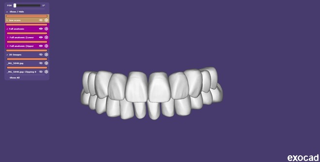 Digital Diagnostic Mock Up, Wax Up – CAD Design