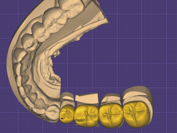 Dental Cad Service: Single crowns&bridges