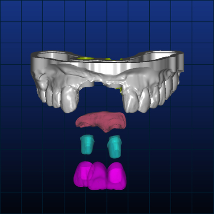 Custom abutment - CadCam Masters