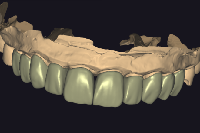 Veneers Design