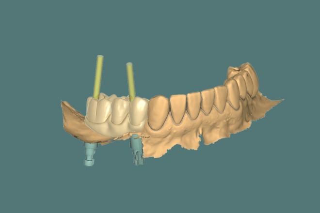 IMPLANT CROWN AND BRIDGE - CadCam Masters