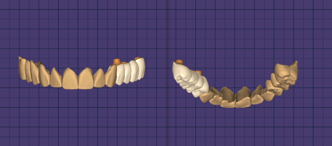 Veneers - CadCam Masters